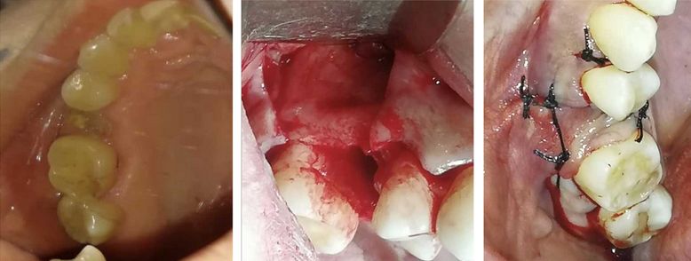 Infekcja zębopochodna w okolicy wstrzyknięcia IDF