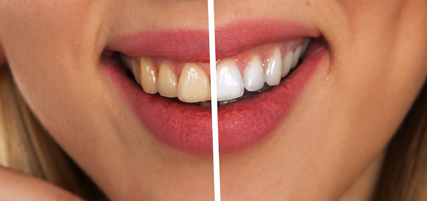 Żółte zęby: nie dość atrakcyjne, ale również niezdrowe?