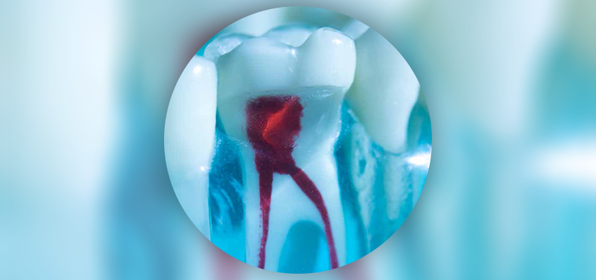Rewolucja czy ewolucja uszczelniaczy kanałowych w kierunku bioaktywnego leczenia endodontycznego
