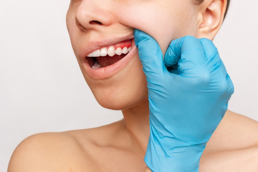 Periodontitis i rak jamy ustnej: jaka jest między nimi zależność?