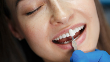 Licówki na krzywe zęby - dentysta przymierzający licówkę do zębów pacjentki