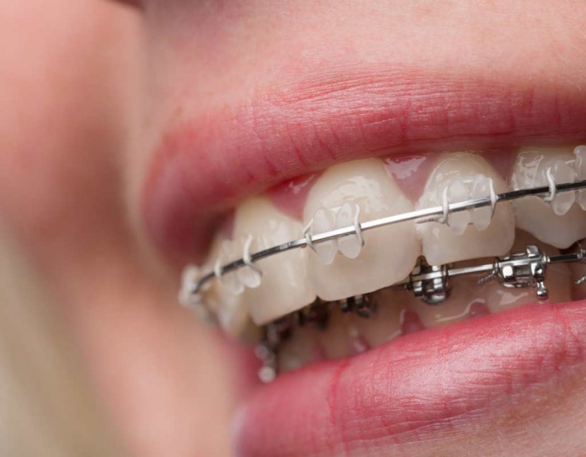 Czy aplikacja dla pacjentów orto ma wpływ na higienę jamy ustnej?