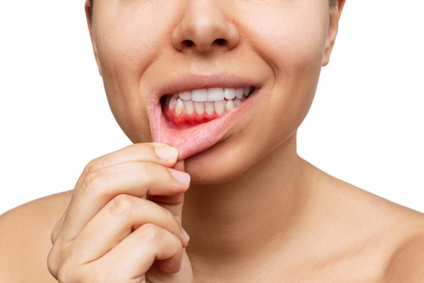USA: czy nowatorski żel zwalczy objawy periodontitis?