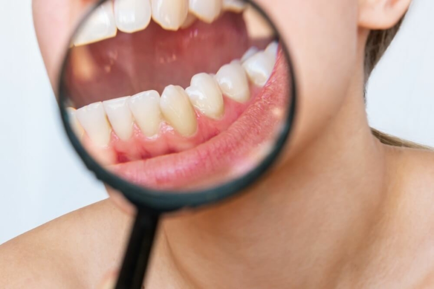 Periodontitis i rak jamy ustnej: jaka jest między nimi zależność?