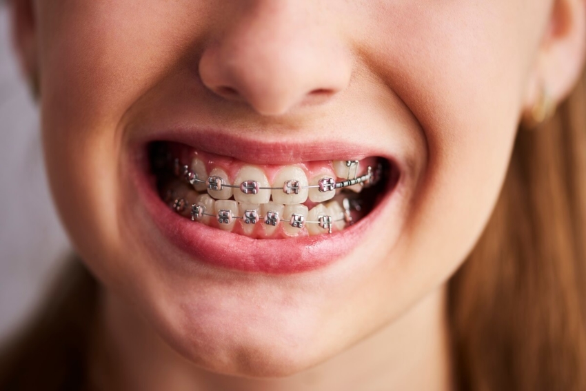 Sześć głównych powodów przesuwania się zębów u pacjentów