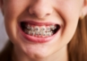 Sześć głównych powodów przesuwania się zębów u pacjentów