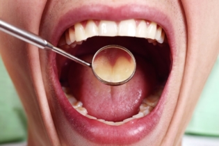 choroby jamy ustnej
