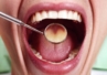 Jednorazowy depresor języka a diagnoza chorób jamy ustnej