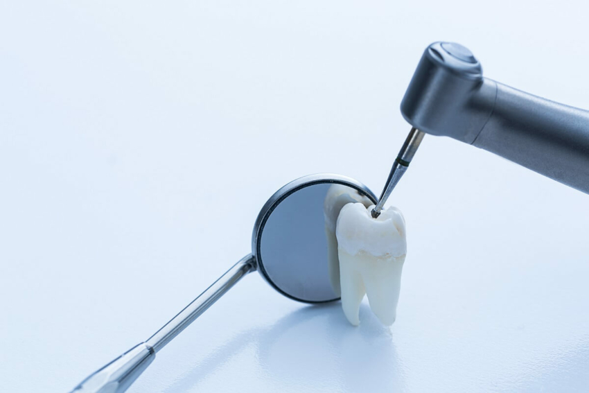USA: wyraźny odwrót od amalgamatu w stomatologii