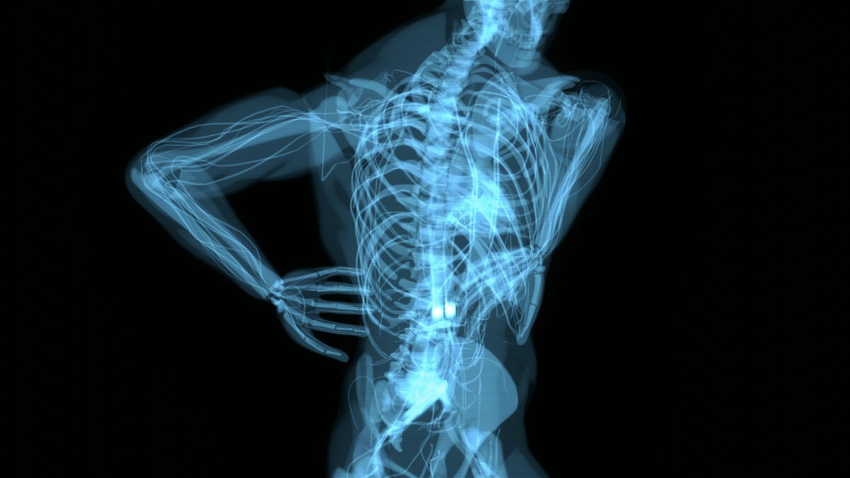 Hipofosfatazja – choroba kruchych kości
