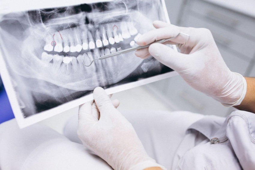 Proteza czy implanty – jak uzupełnić braki zębowe?
