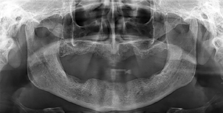 Nifedypina i przerost błony śluzowej jamy ustnej u pacjenta z bezzębiem