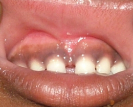 Frenektomia laserowa 5