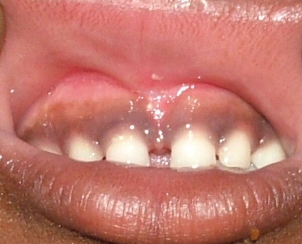 Frenektomia laserowa 5
