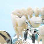 periodontitis a implanty