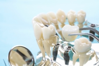 periodontitis a implanty