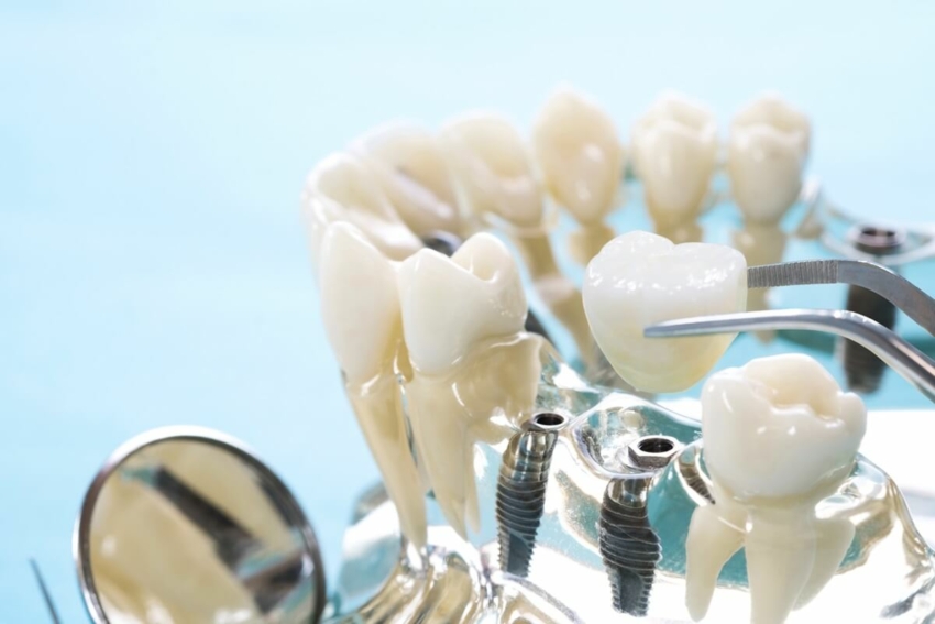 Periodontitis bez związku z niepowodzeniem implantacji?