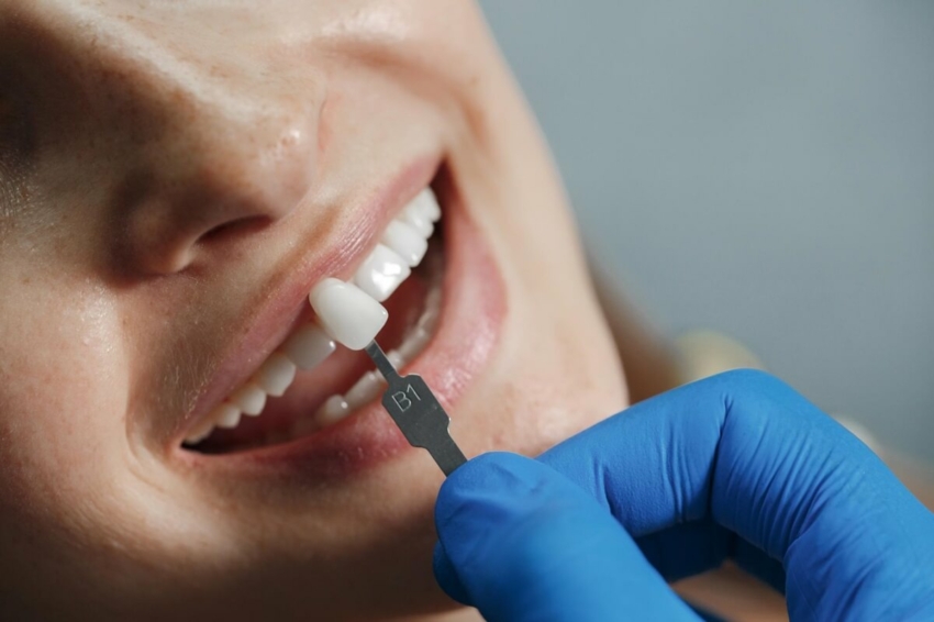 Licówki na jedynki i dwójki. Czy warto zakładać licówki dentystyczne na przednie zęby?