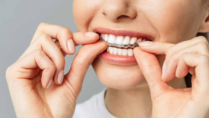 Aparat Invisalign vs. tradycyjne metody prostowania zębów