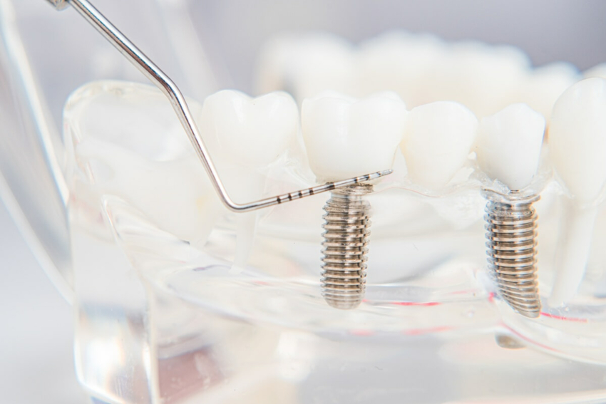 Globalny rynek implantów dentystycznych przyspiesza