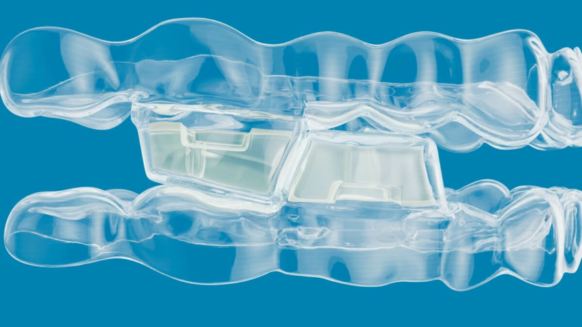 System Invisalign® Mandibular Advancement z blokami okluzyjnymi do korekcji szkieletowej i zębowej klasy II