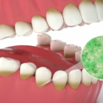 Fusobacterium nucleatum