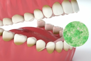 Fusobacterium nucleatum