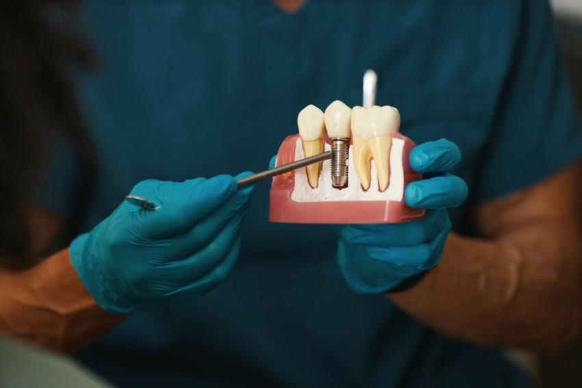Co jeść po wszczepieniu implantu zęba? Zalecenia i wskazówki