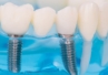 Czy ultradźwięki HIFU mogą eliminować biofilm z implantów?
