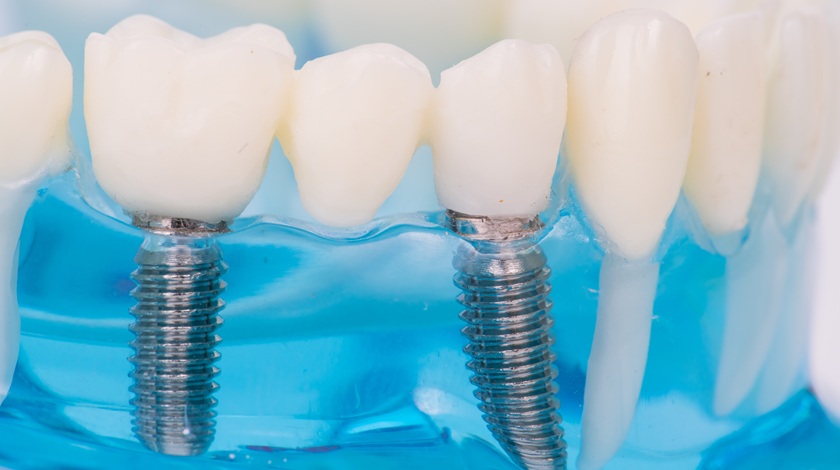 Czy ultradźwięki HIFU mogą eliminować biofilm z implantów?