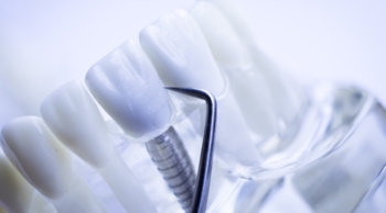 Odbudowa kości pod implanty - model implantu zęba