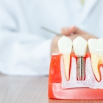 Odrzucenie implantu zęba - model implantu zęba