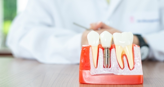 Przyczyny odrzucenia implantu zęba, czyli dlaczego implant się nie przyjął