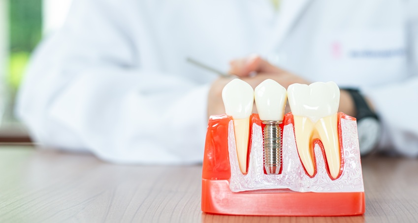 Przyczyny odrzucenia implantu zęba, czyli dlaczego implant się nie przyjął