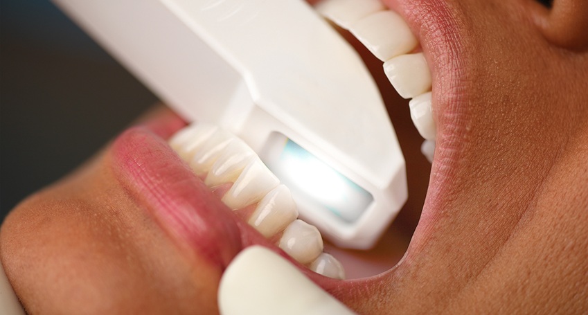 System Invisalign® – jak wygląda cyfrowe planowanie i leczenie ortodontyczne?