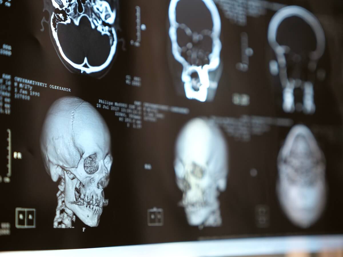 Wąska szczęka i anatomia nosa: badanie na szczurach wskazuje na możliwy mechanizm