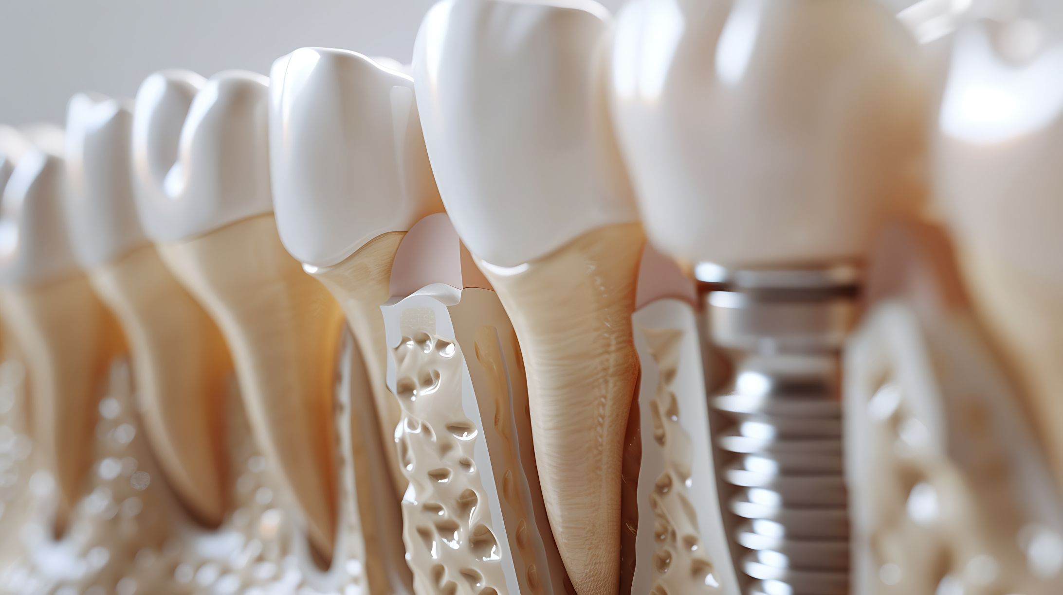 Periodontitis a implanty: czy stopień choroby ma większe znaczenie niż jej stadium?
